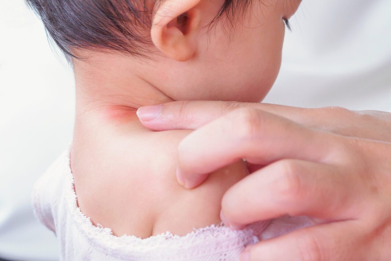 eczema on baby neck