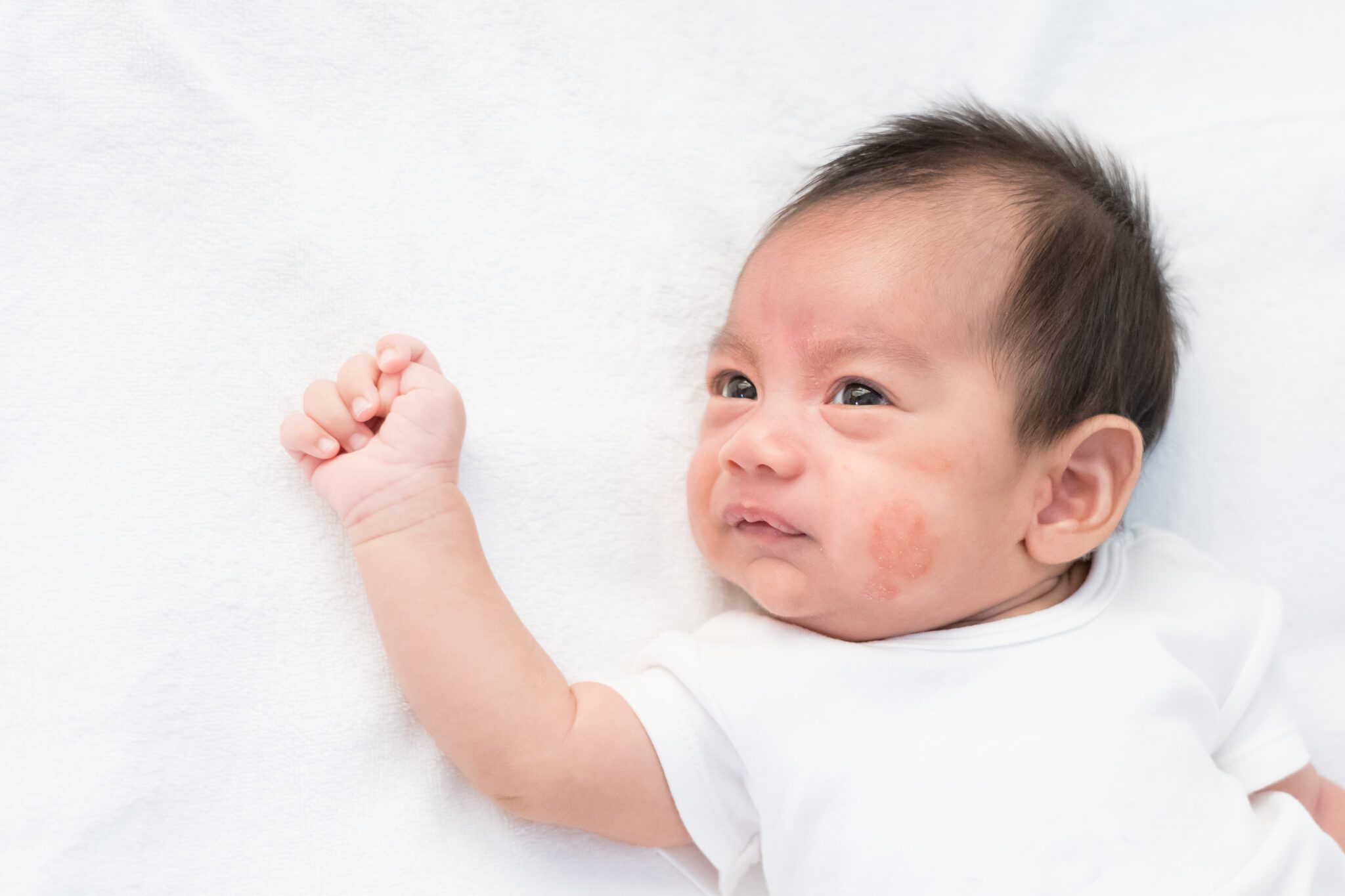 identifying-and-treating-baby-rash-on-face-bldg-active