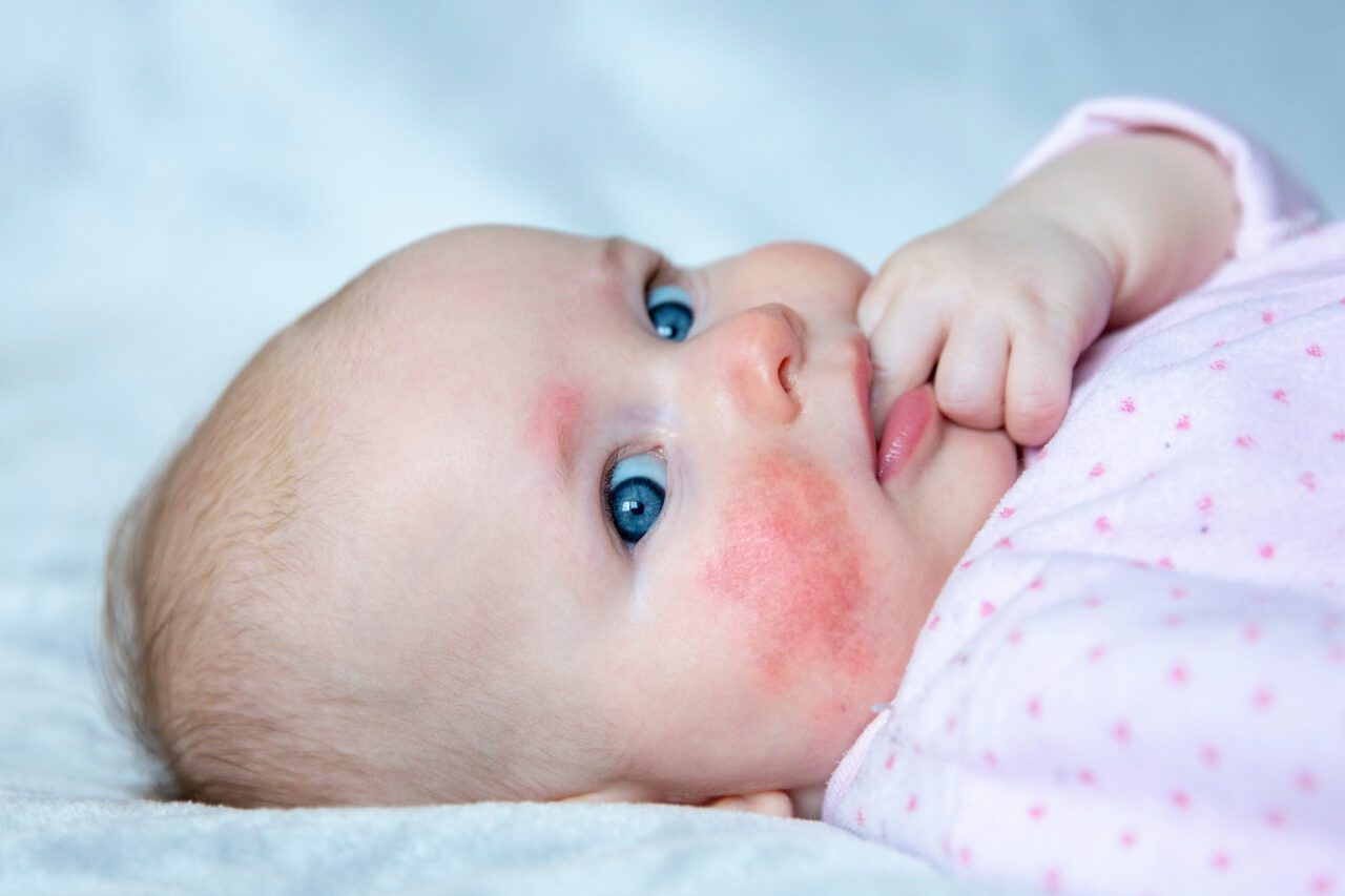 Caring For Baby Rash On Stomach A Parent s Guide BLDG Active