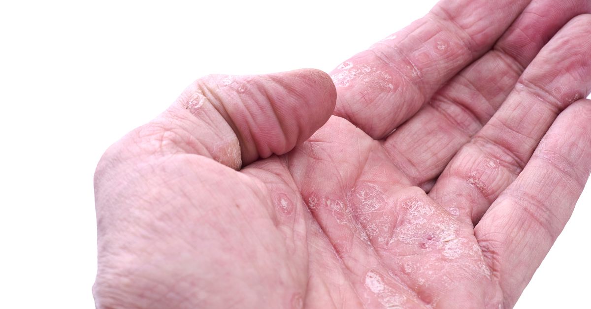 Managing Skin Rashes: Tips for Hand Foot and Mouth - BLDG Active