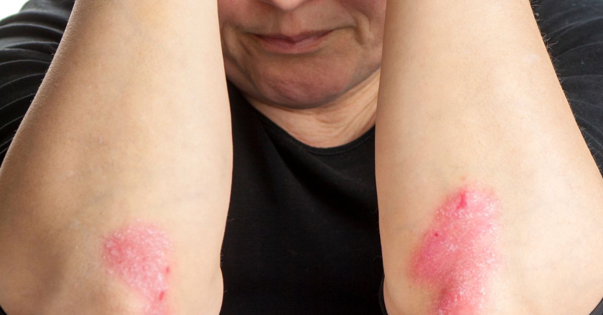 Inverse Psoriasis: Causes and Comfort - BLDG Active