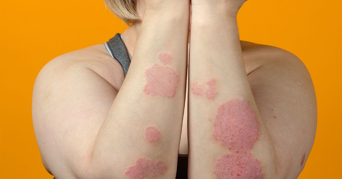 Understanding Psoriasis Types And Triggers Bldg Active