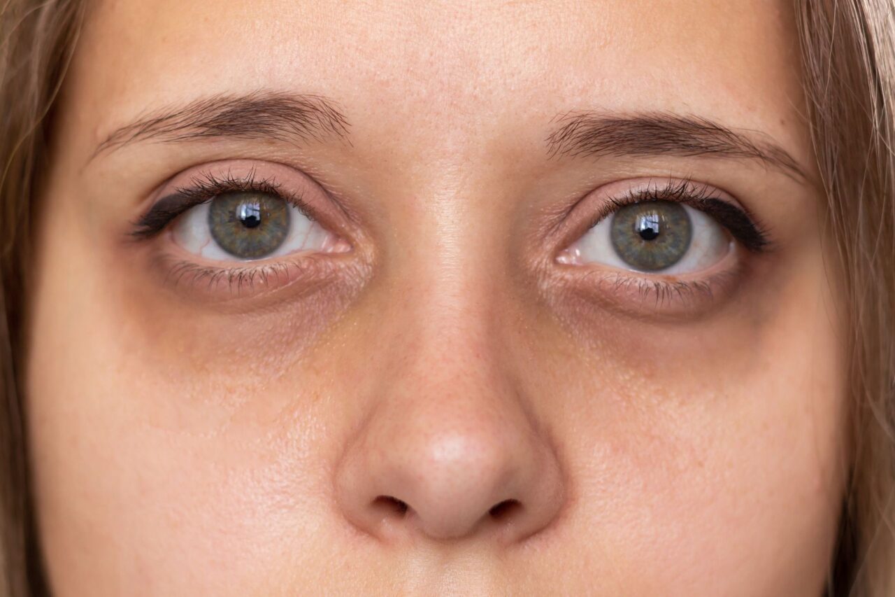 The Best Hypochlorous Acid Spray for Eyes
