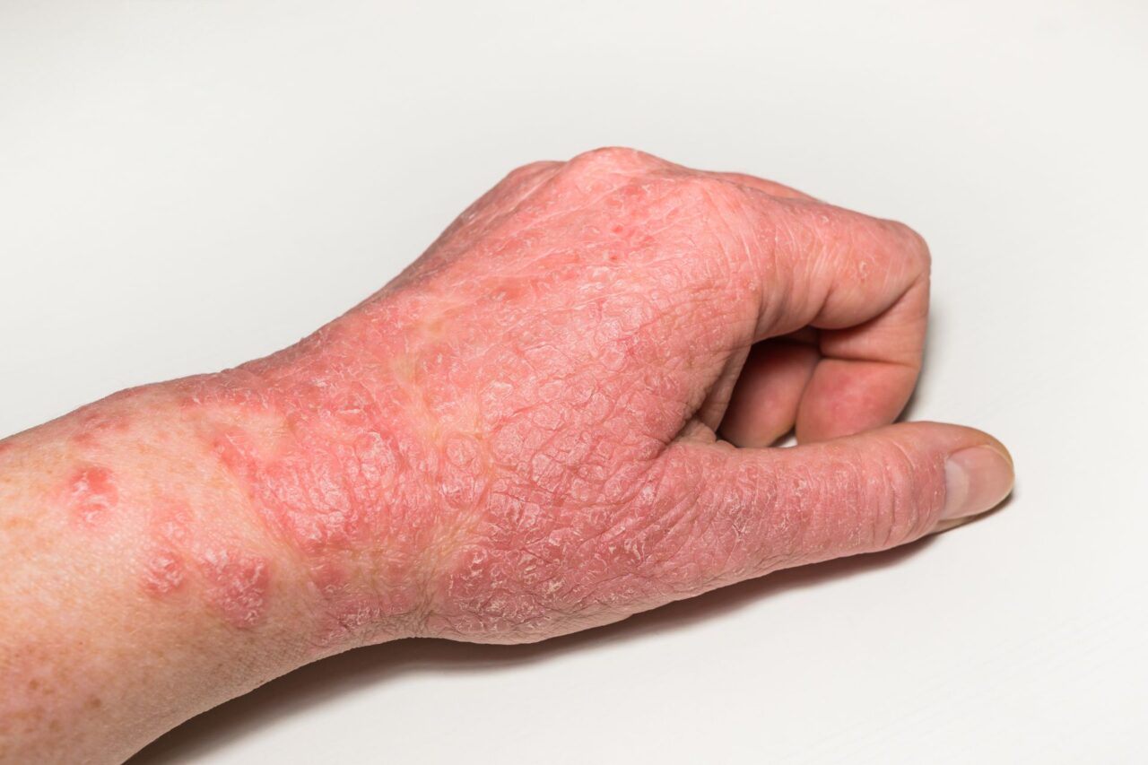 Combatting Eczema Inflammation with Hypochlorous Acid
